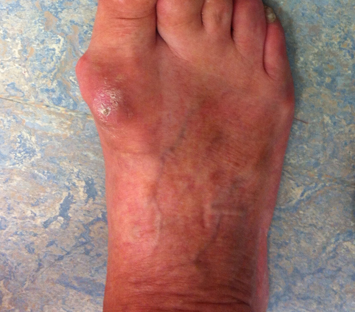 What-is-Hallux-Rigidus-