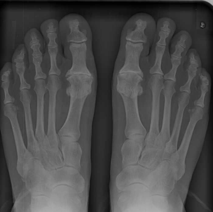 What-is-the-Best-Treatment-for-Hallux-Rigidus-Without-Surgery-