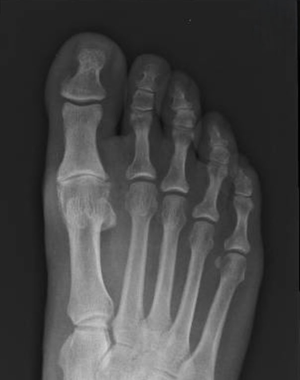 How-is-Hallux-Rigidus-Diagnosed-–-Do-I-Need-an-X-Ray-